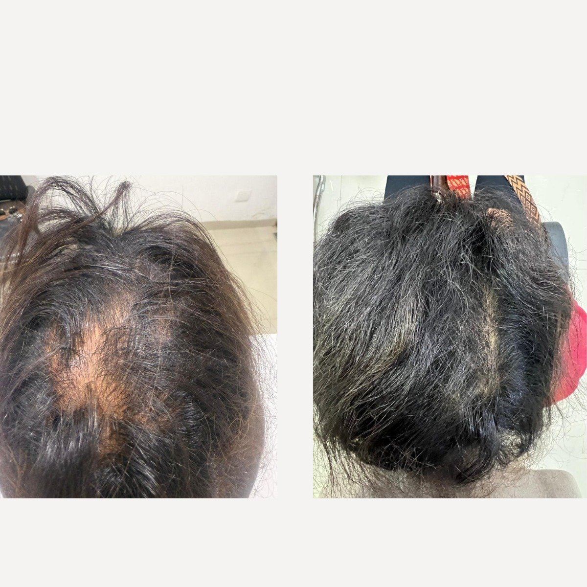 Hair PRP Treatment